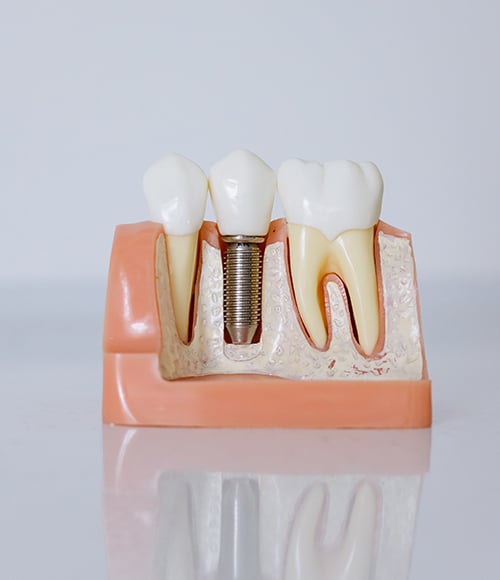 Implantat Gebiss